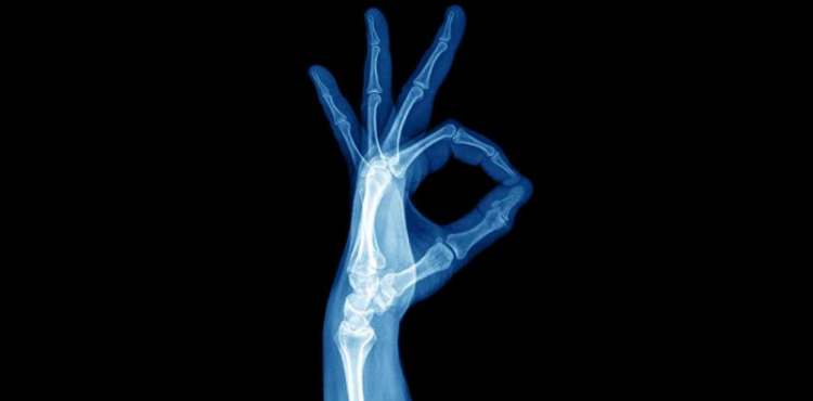 5 Lessons Learned from a Broken Wrist
